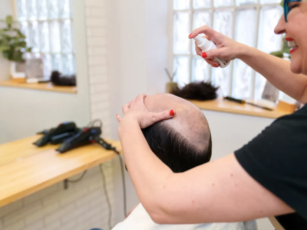 Stylist spraying treatment on bald scalp – Male Hair Treatment Birmingham.