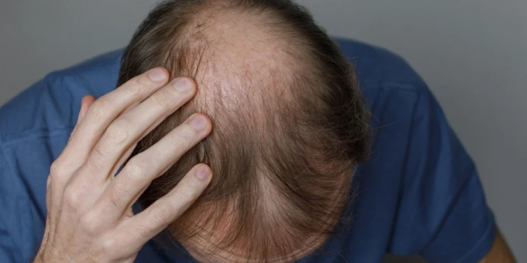 Advanced hair loss treatment at the Best Hair Loss Clinic in Birmingham for fuller, healthier hair.