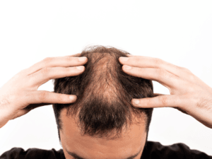 Man examining scalp for hair loss, looking for Thinning Hair Treatments in Birmingham.
