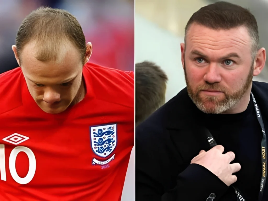 Before and after Hair Transplant Famous Actors UK with improved hairline and fuller look.