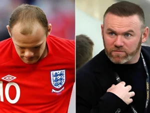 Before and after Hair Transplant Famous Actors UK with improved hairline and fuller look.