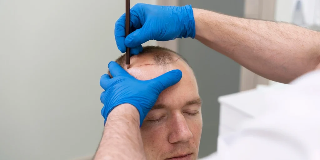 Doctor marking hairline on patient’s head before transplant procedure using Men’s Hair Systems.