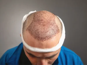 Close-up of patient’s scalp healing after Hair Transplants in Birmingham treatment.