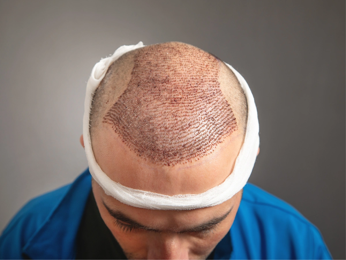Close-up of patient’s scalp healing after Hair Transplants in Birmingham treatment.