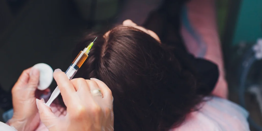 Is Hair Exosome Treatment Birmingham showing precise scalp injection therapy for hair regrowth in a clinical setting