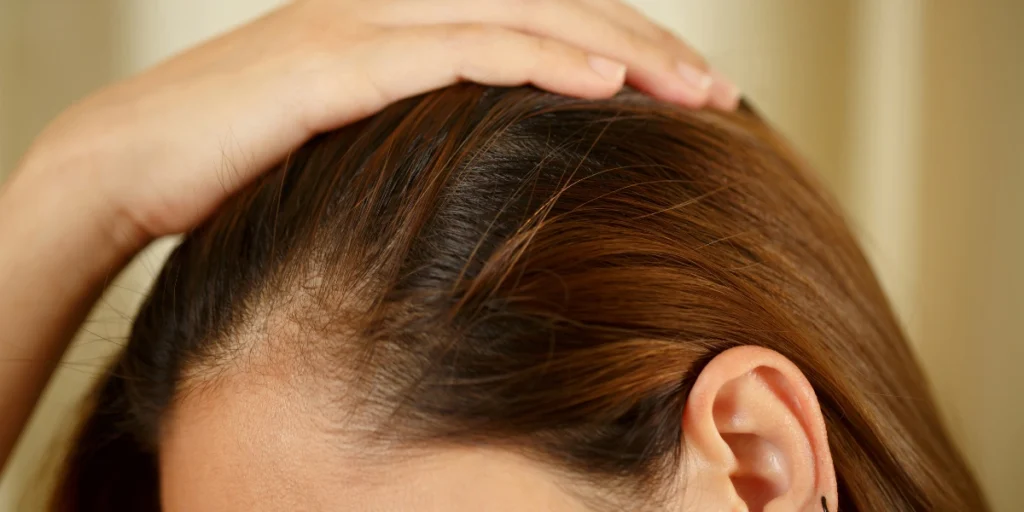 Close-up of thinning hairline showing scalp health before regenerative hair loss treatments UK