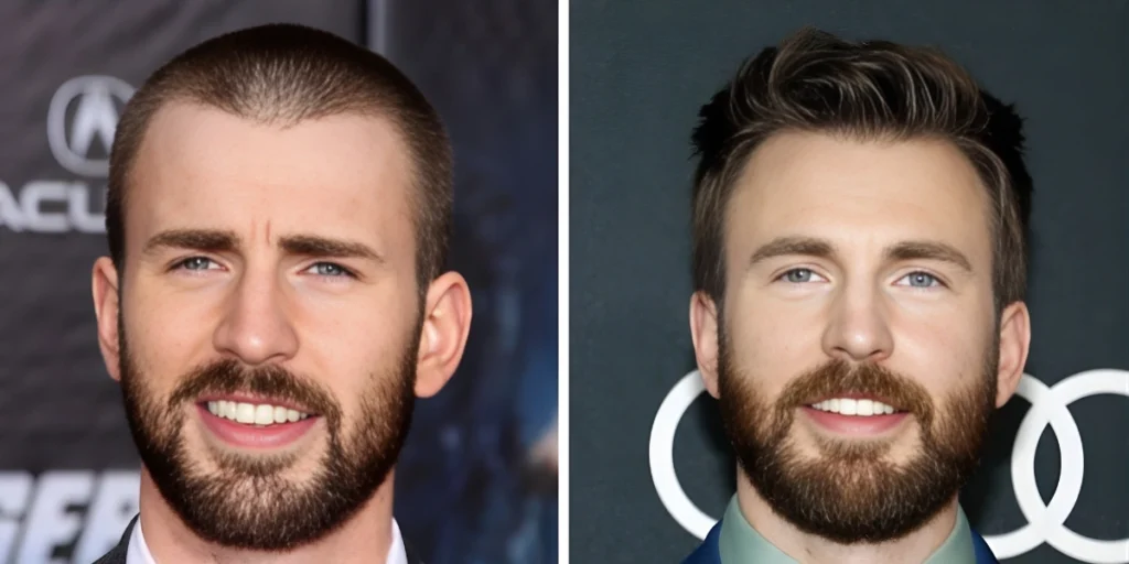 Hair Systems vs Hair Transplants comparison showing before and after hair restoration results for natural-looking density