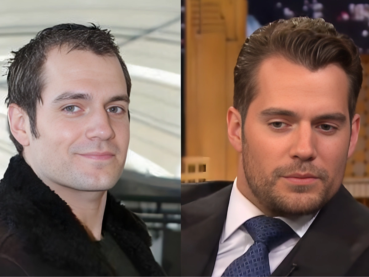 Hair Systems vs Hair Transplants visual comparison demonstrating non-surgical and surgical hair restoration outcomes