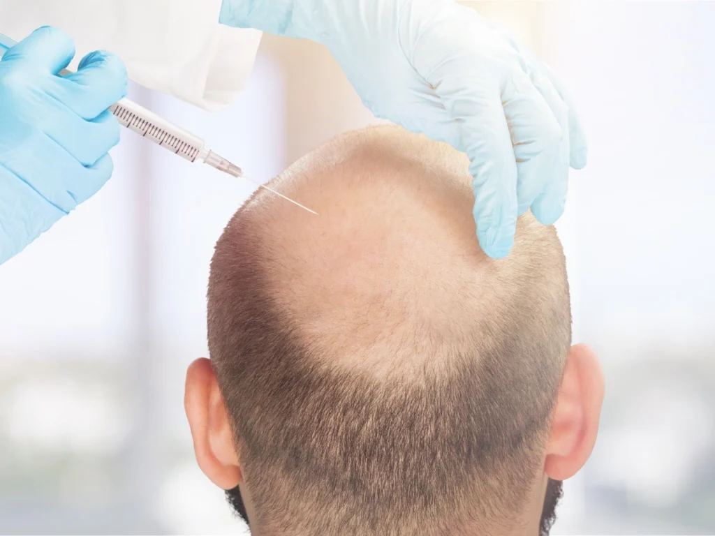 Close-up of PRP injection procedure for Regenerative Hair Restoration UK hair regrowth treatment.