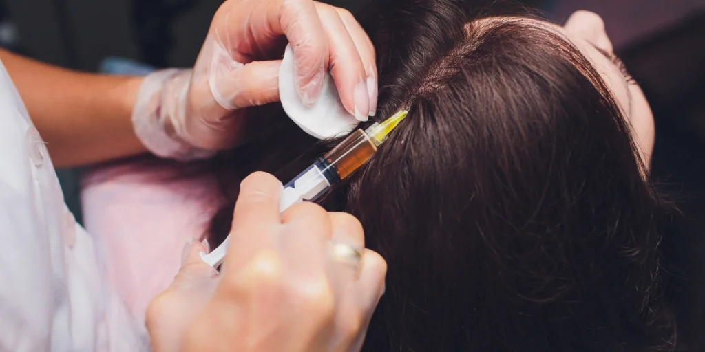Exosome therapy vs hair transplant UK showing scalp injection treatment for hair regeneration and thinning hair recovery