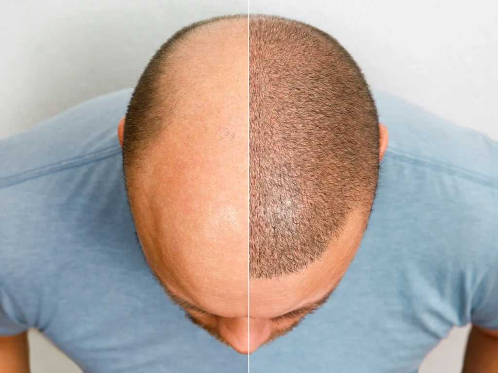 Exosome therapy vs hair transplant UK before and after comparison of bald scalp and restored hair growth results
