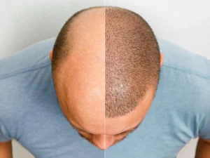 Exosome therapy vs hair transplant UK before and after comparison of bald scalp and restored hair growth results
