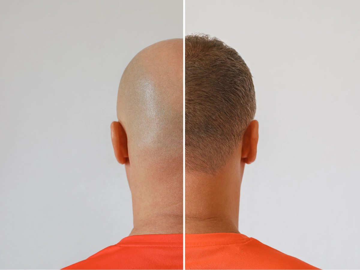 Back view before and after result showing bald scalp vs full hair growth illustrating hair transplant longevity UK